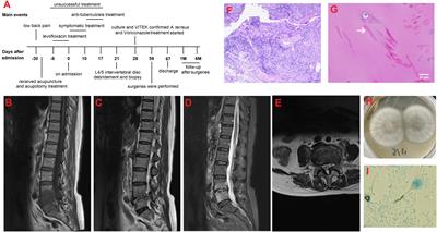 Aspergillus terreus spondylodiscitis following acupuncture and acupotomy in an immunocompetent host: case report and literature review